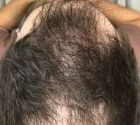 Hair Loss Before and After 12 After