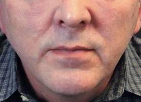 InstaLift Before and After 15 Before
