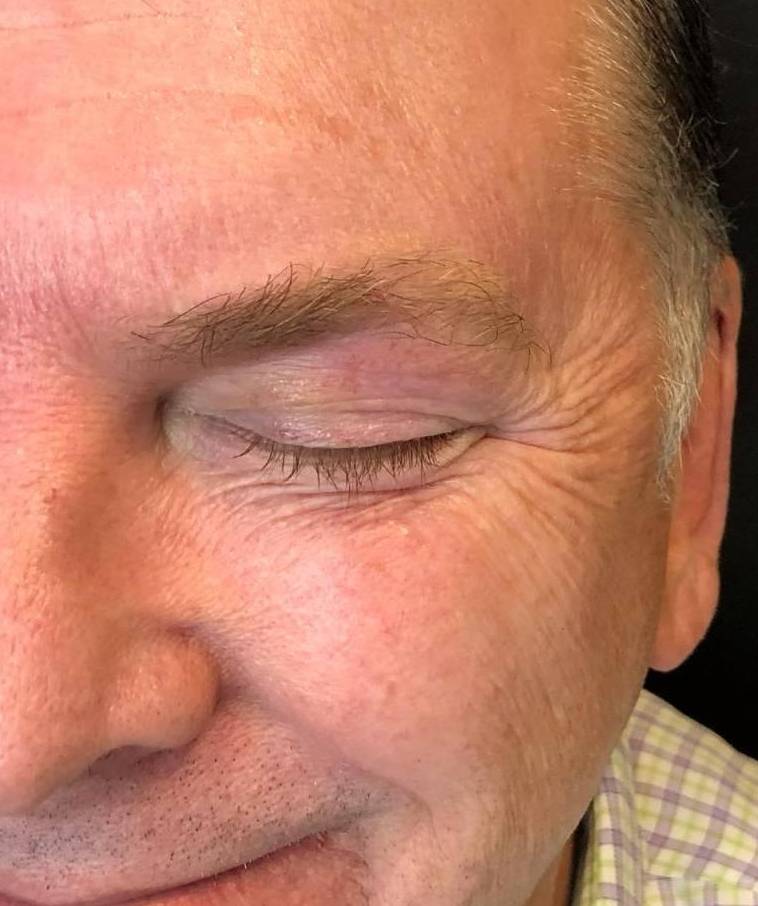 Botox Case 18 Before