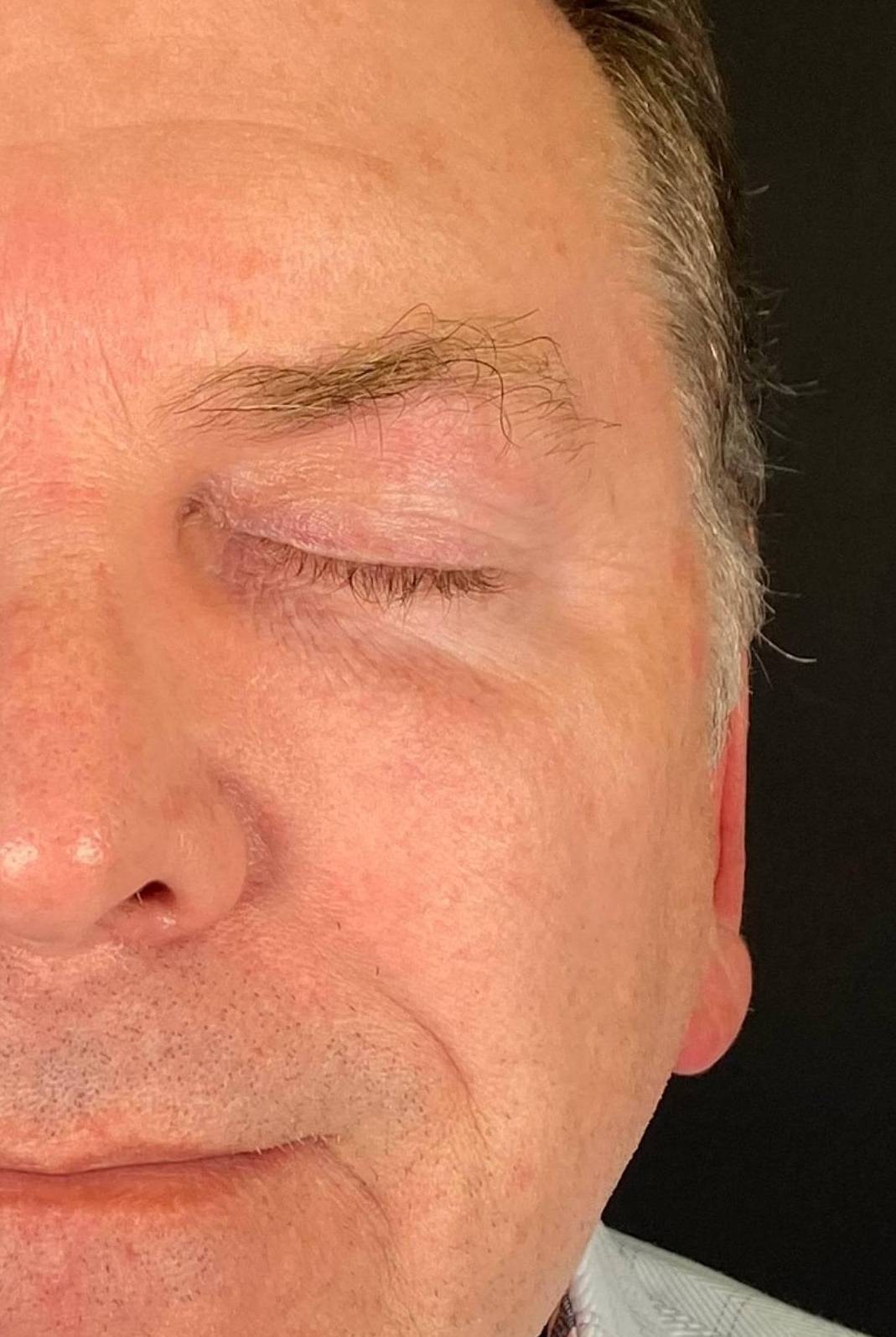 Botox Case 18 After