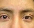 Acne Before and After 19 After