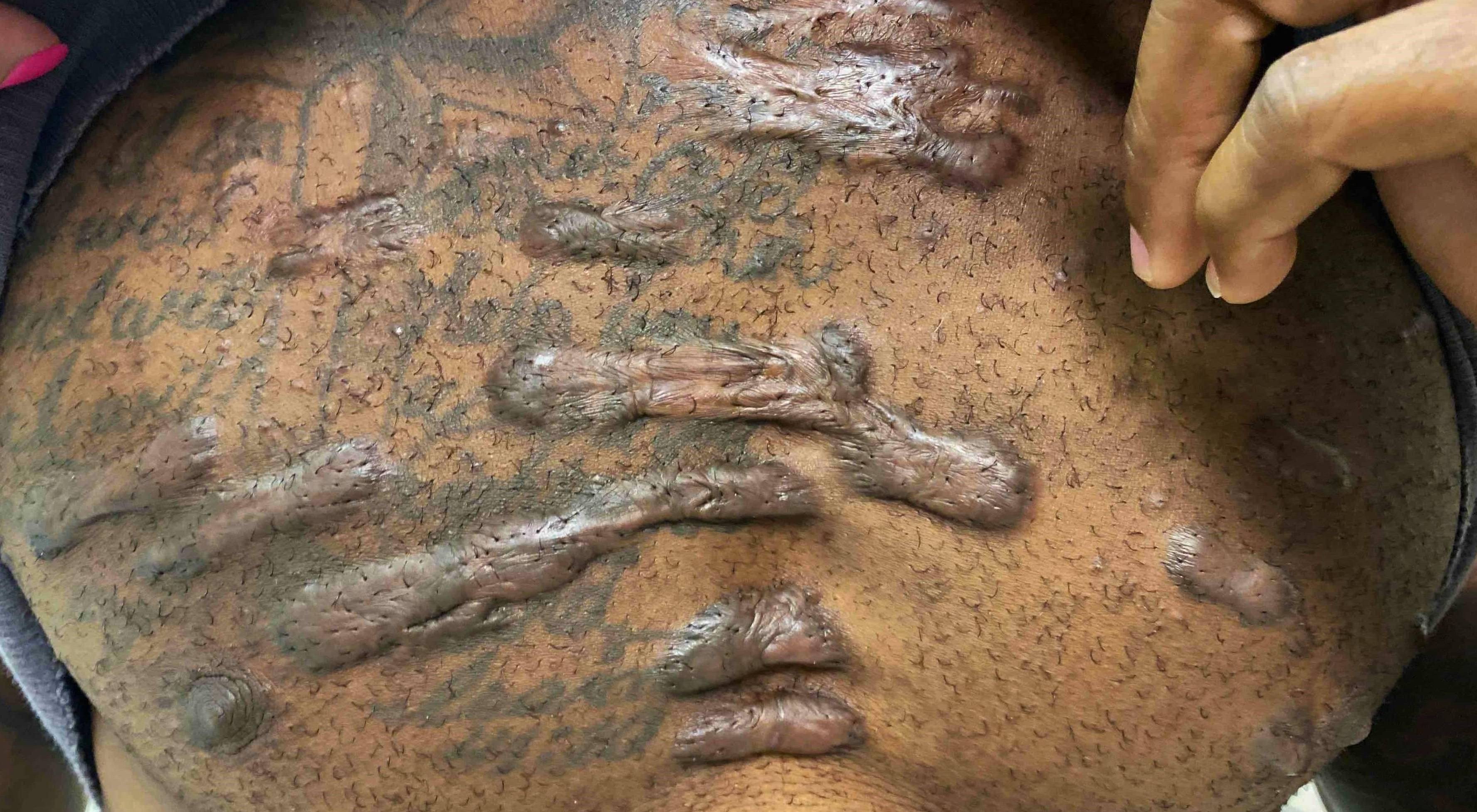 Keloids Before and After 20 Before