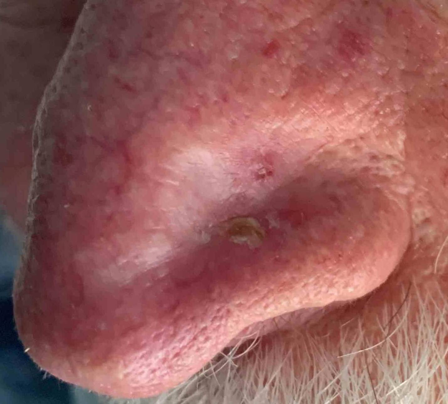 SRT-100 Radiation Before and After 22 After