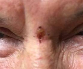SRT-100 Radiation Before and After 23 Before
