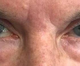 SRT-100 Radiation Before and After 23 After