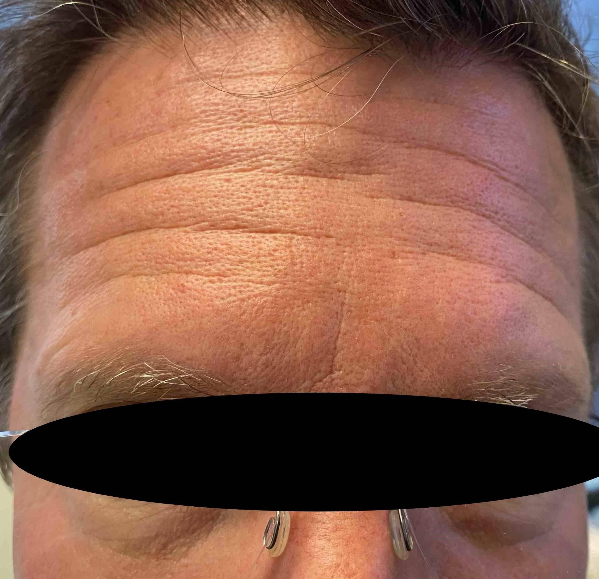 Botox Case 24 Before