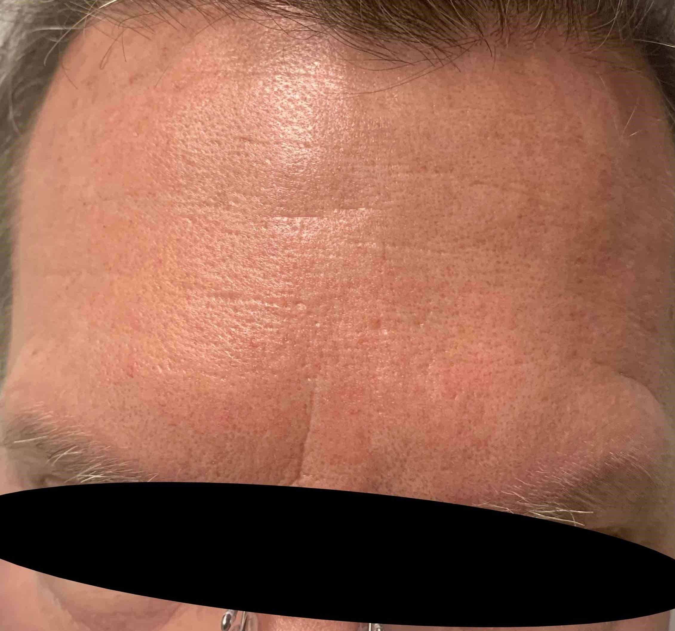 Botox Case 24 After
