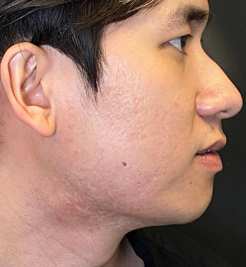 Halo Before and After 25 Before