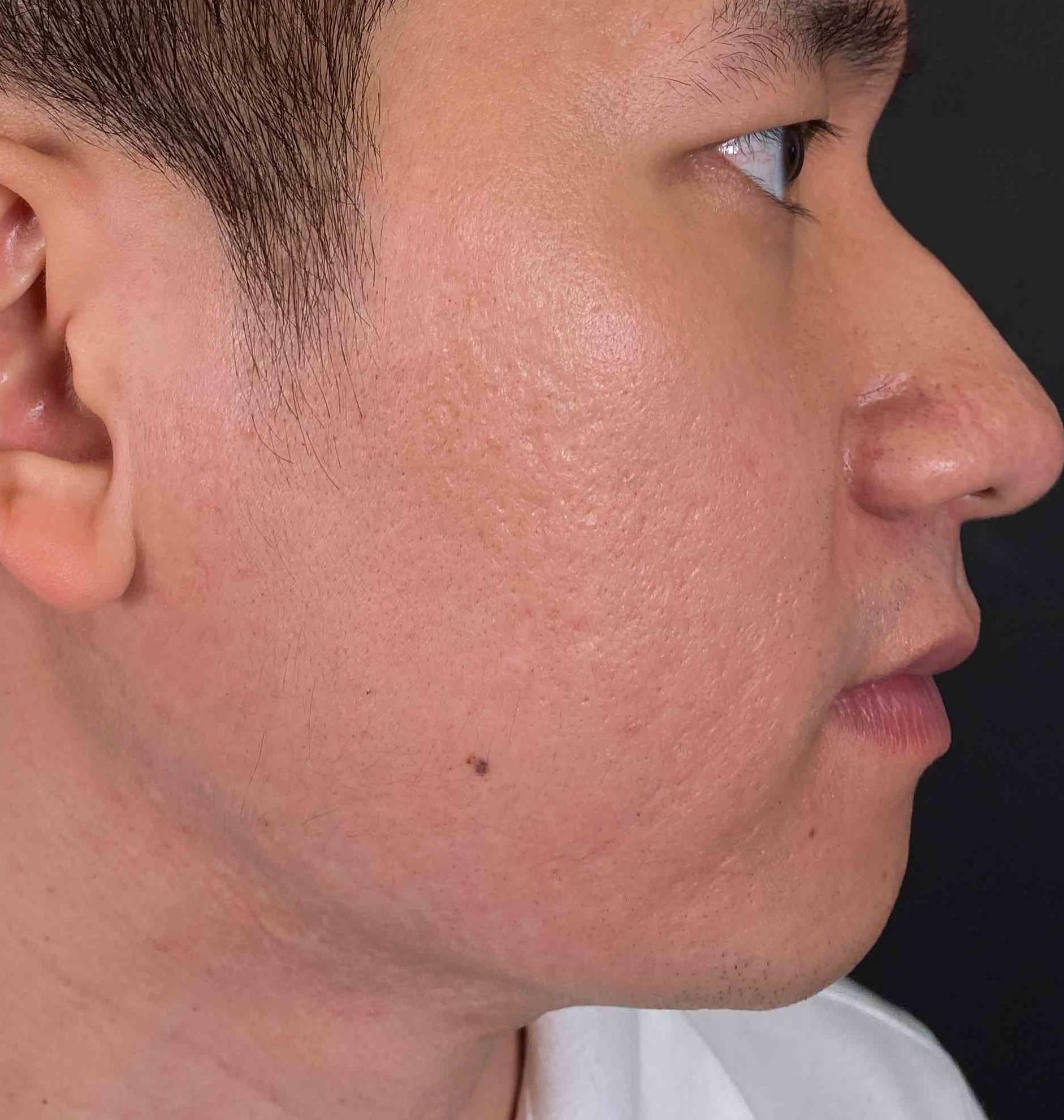 Halo Before and After 25 After
