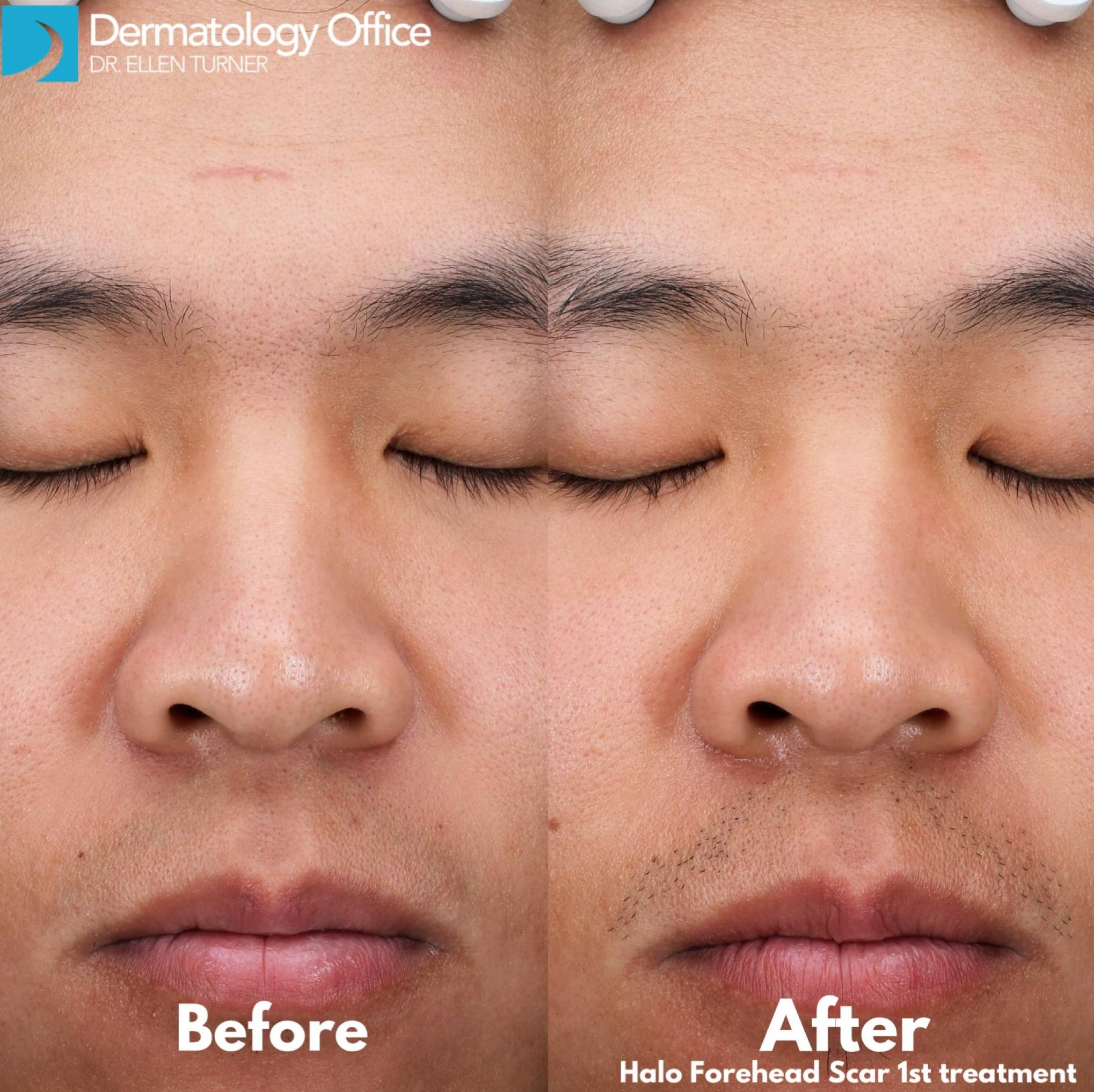 Halo Before and After 26 