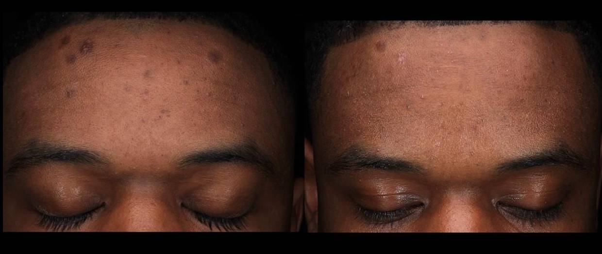 Halo Before and After 27 