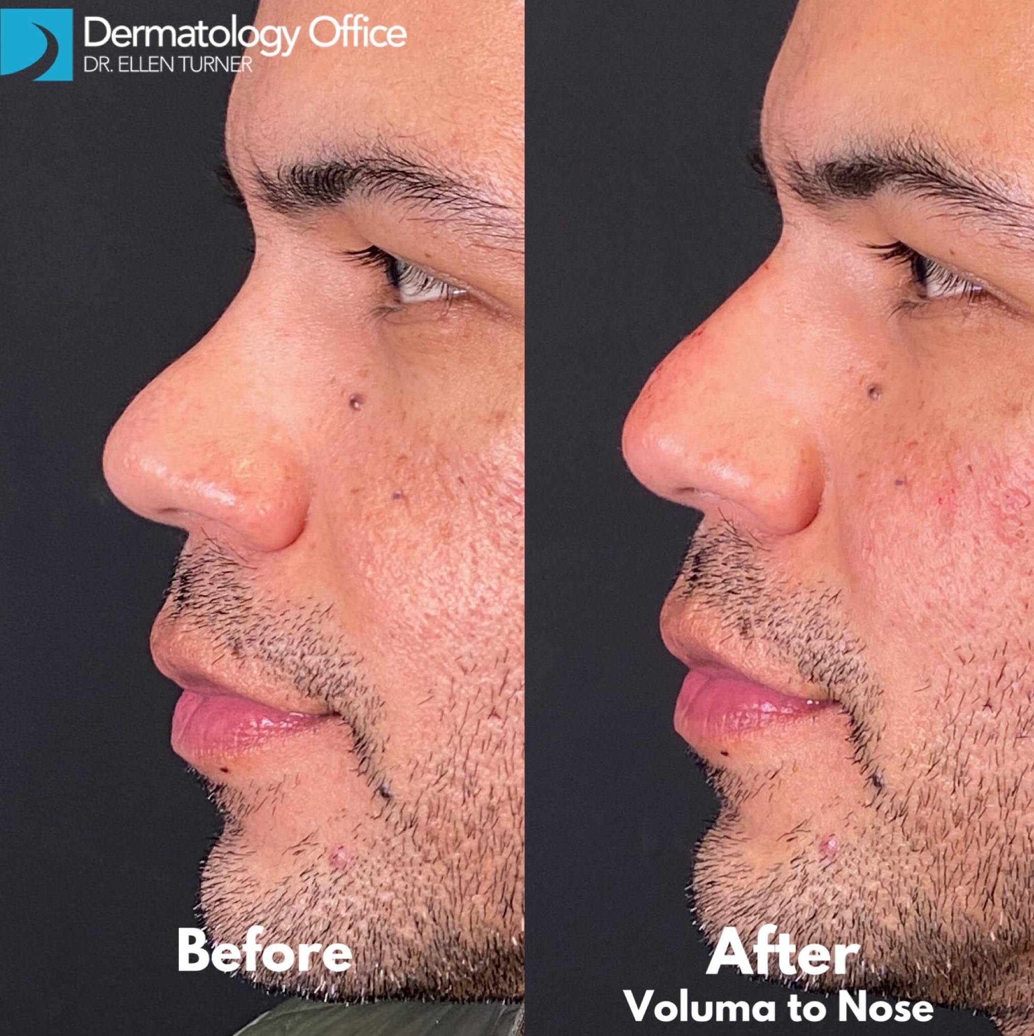 Facial Contouring and Filler for Men 30 