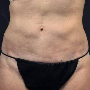 CoolSculpting<sup>®</sup> Before and After Case 3 After