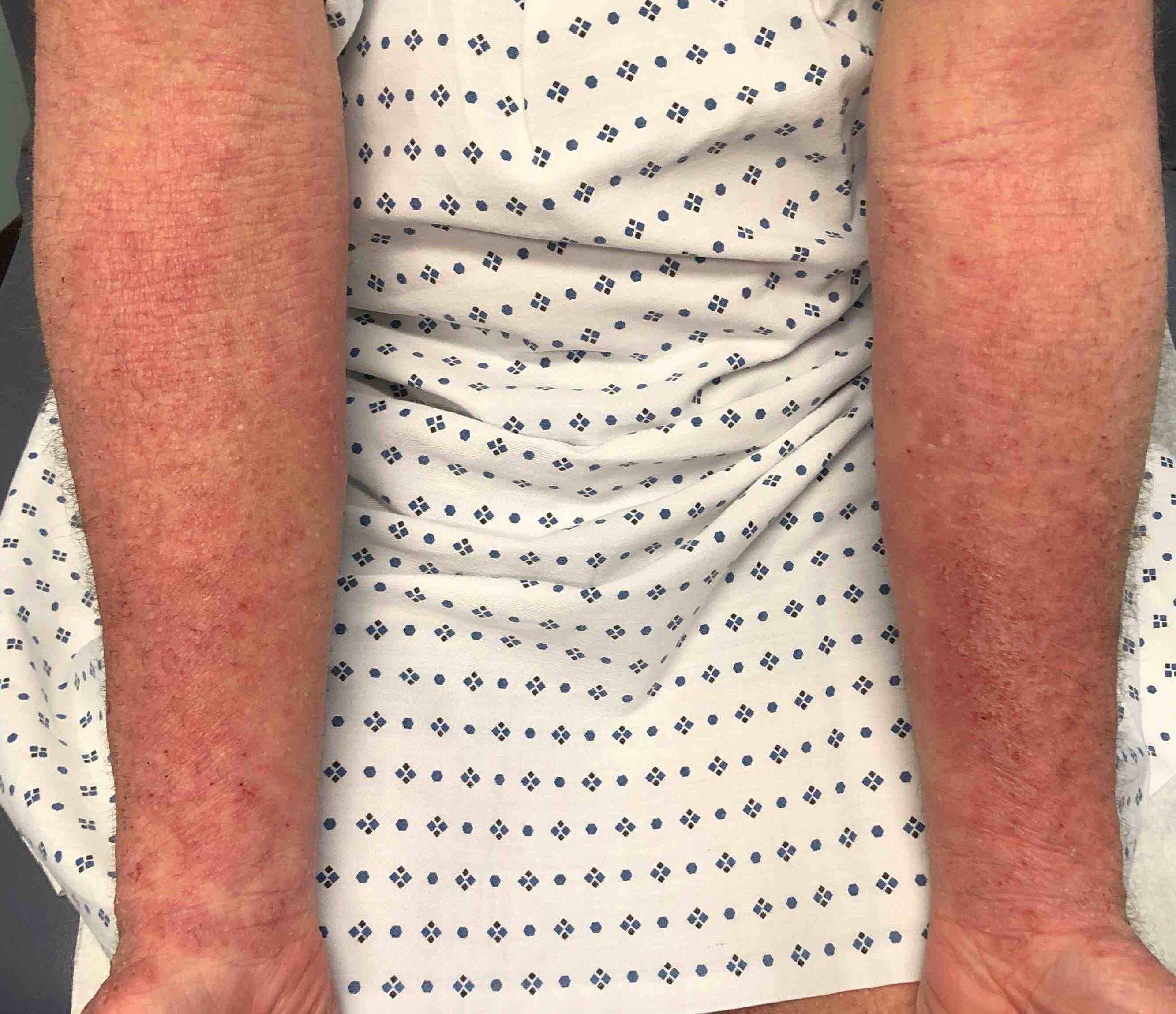 Eczema/ Atopic Dermatitis Before and After 18 Before