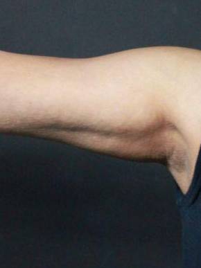 CoolSculpting<sup>®</sup> Before and After Case 4 Before