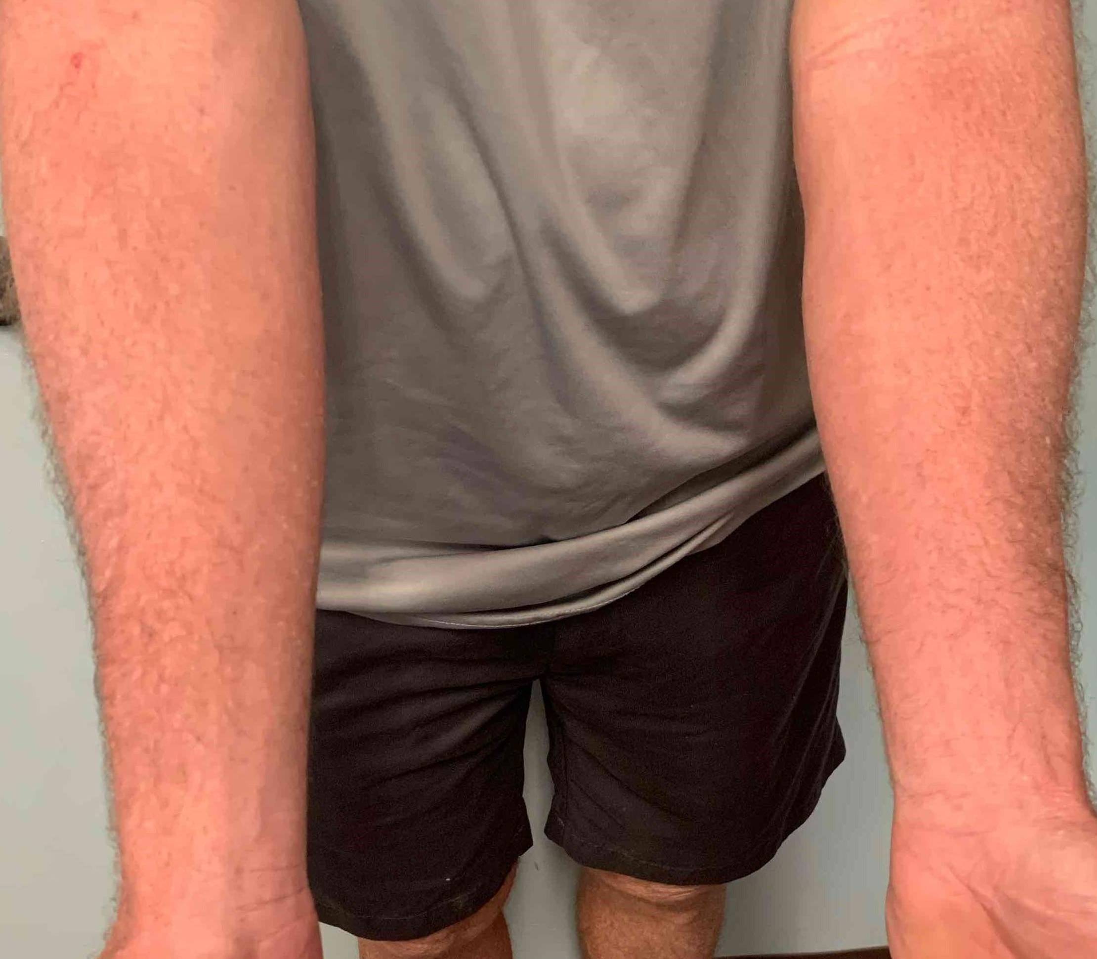 Eczema/ Atopic Dermatitis Before and After 18 After