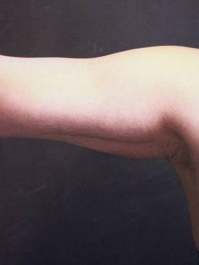 CoolSculpting<sup>®</sup> Before and After Case 4 After