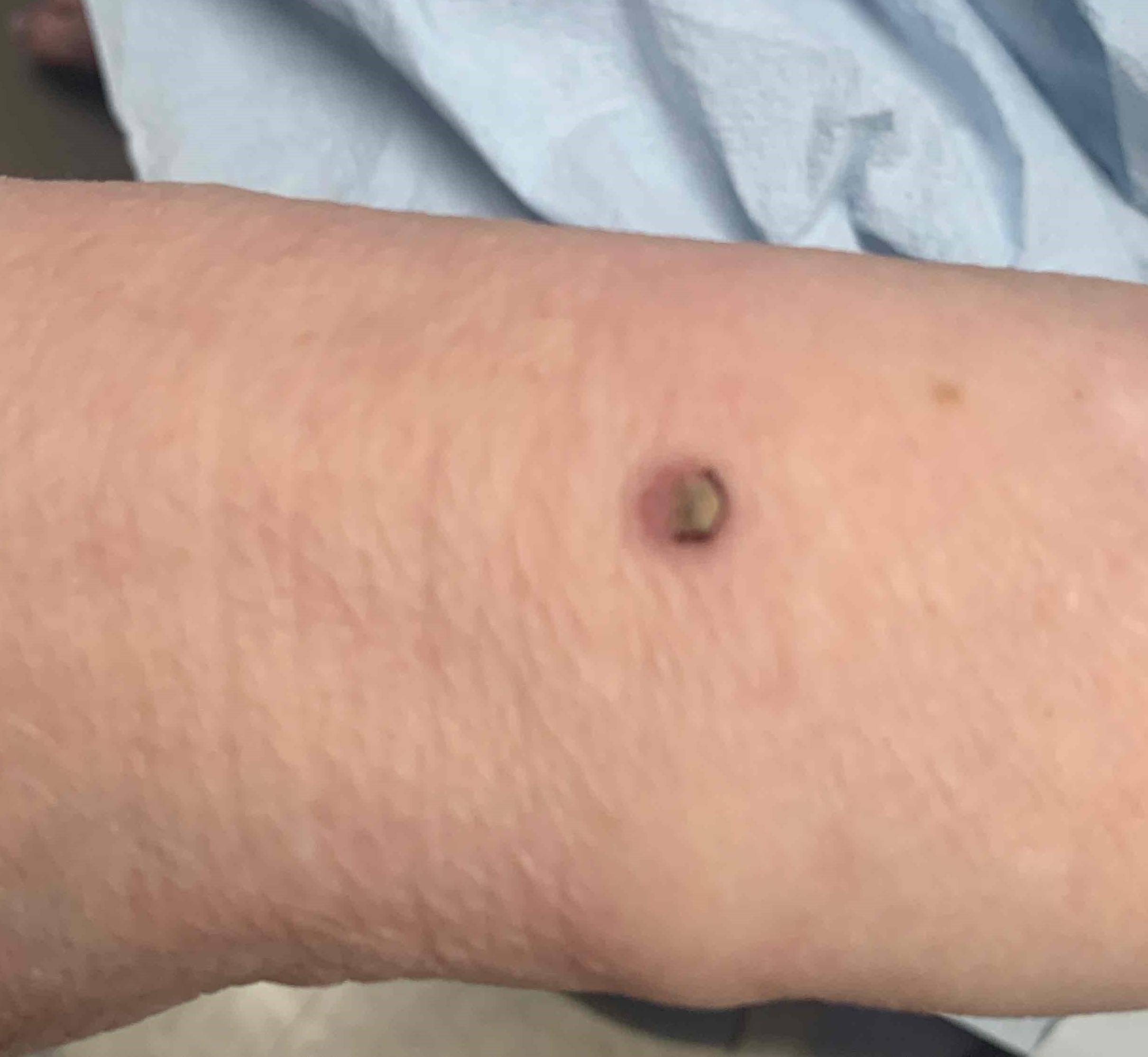 Skin Cancer Before and After Case-30 Before
