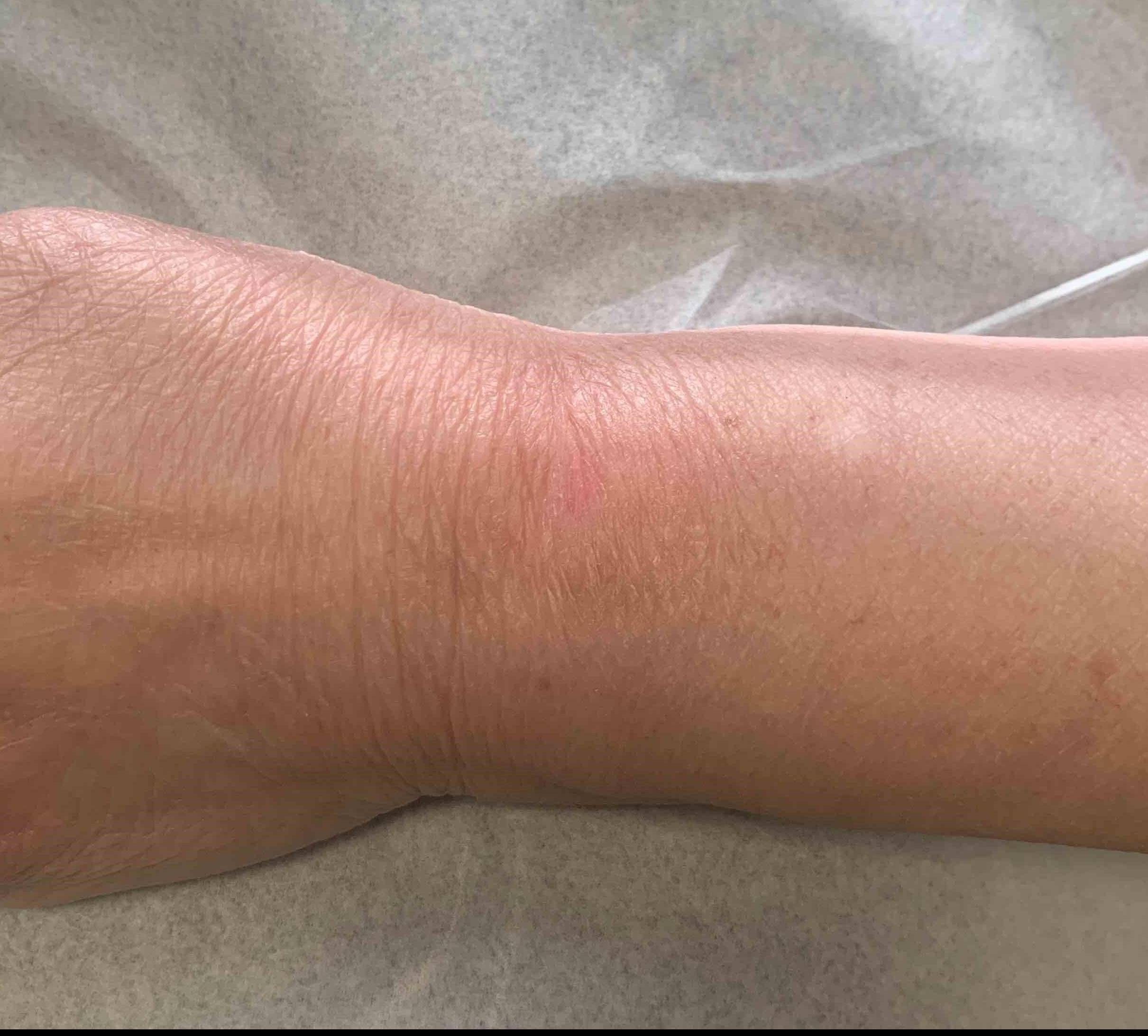 Skin Cancer Before and After Case-30 After