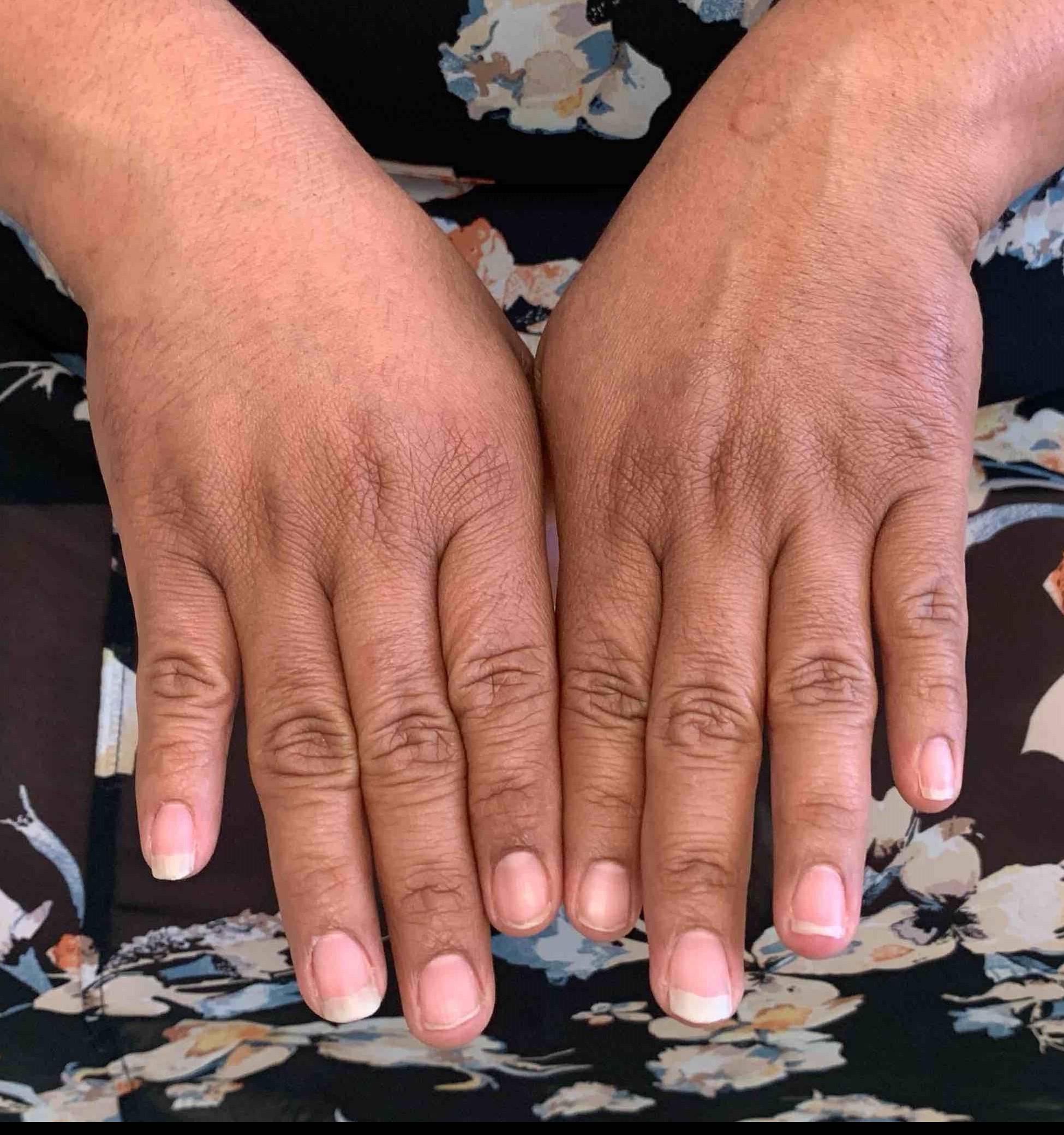 Psoriasis Before and After 33 After