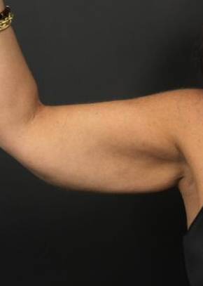 CoolSculpting<sup>®</sup> Before and After Case 5 Before
