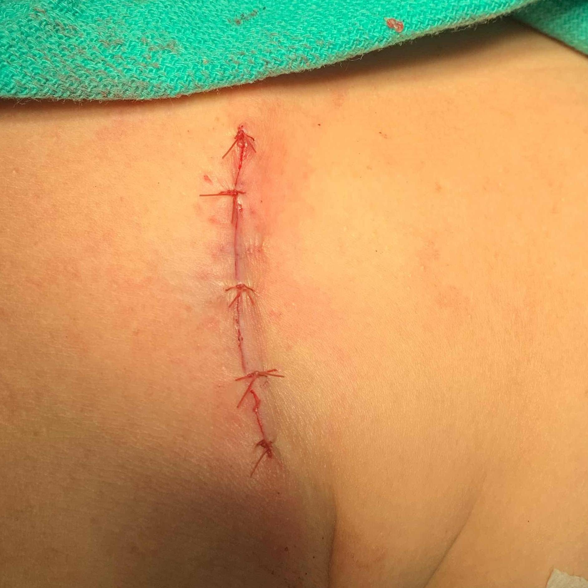 Lipoma Before and After 3 After