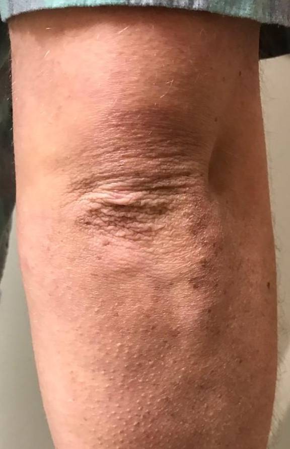 Psoriasis Before and After 34 Before