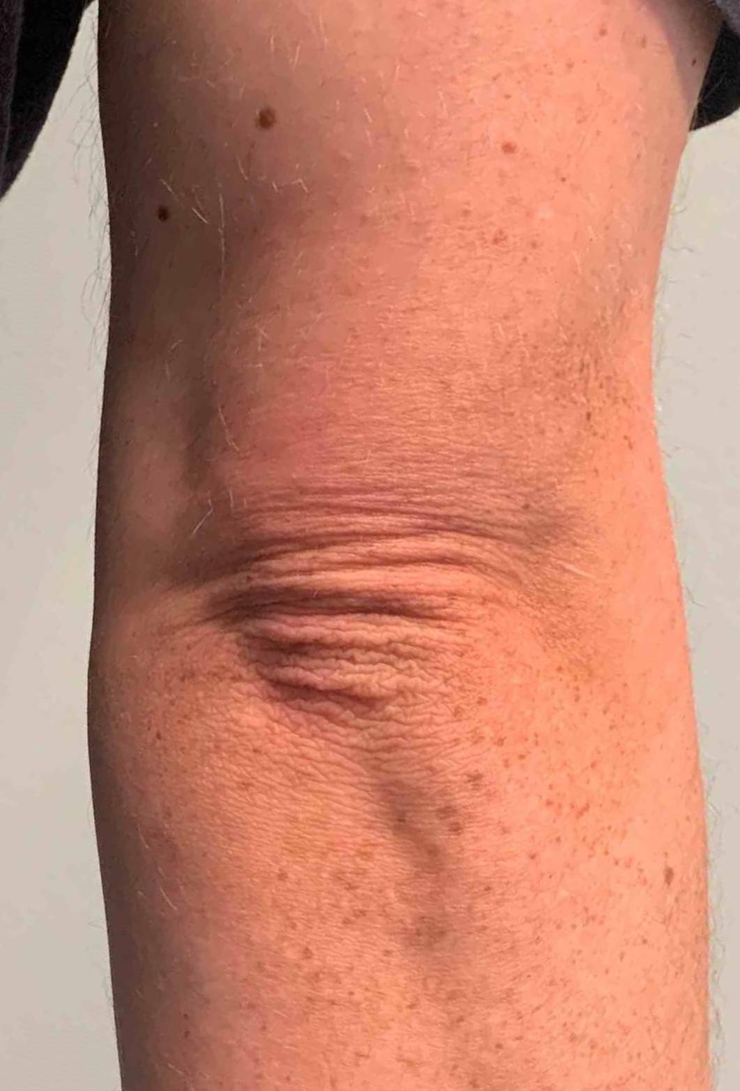 Psoriasis Before and After 34 After