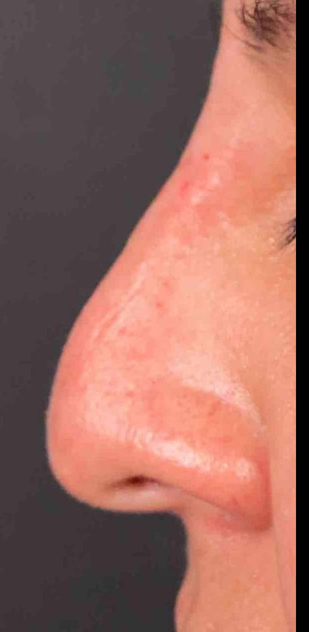 Voluma (1 Syringe) Case-18 After