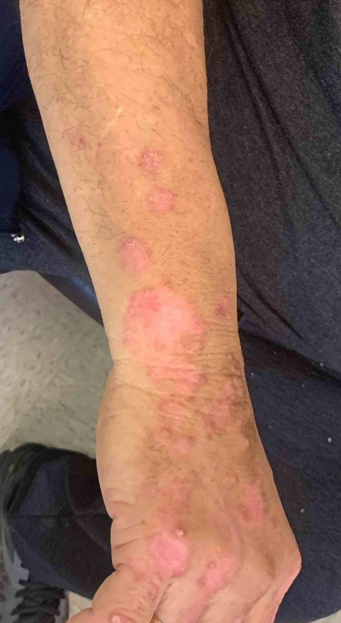 Psoriasis Before and After 36 Before
