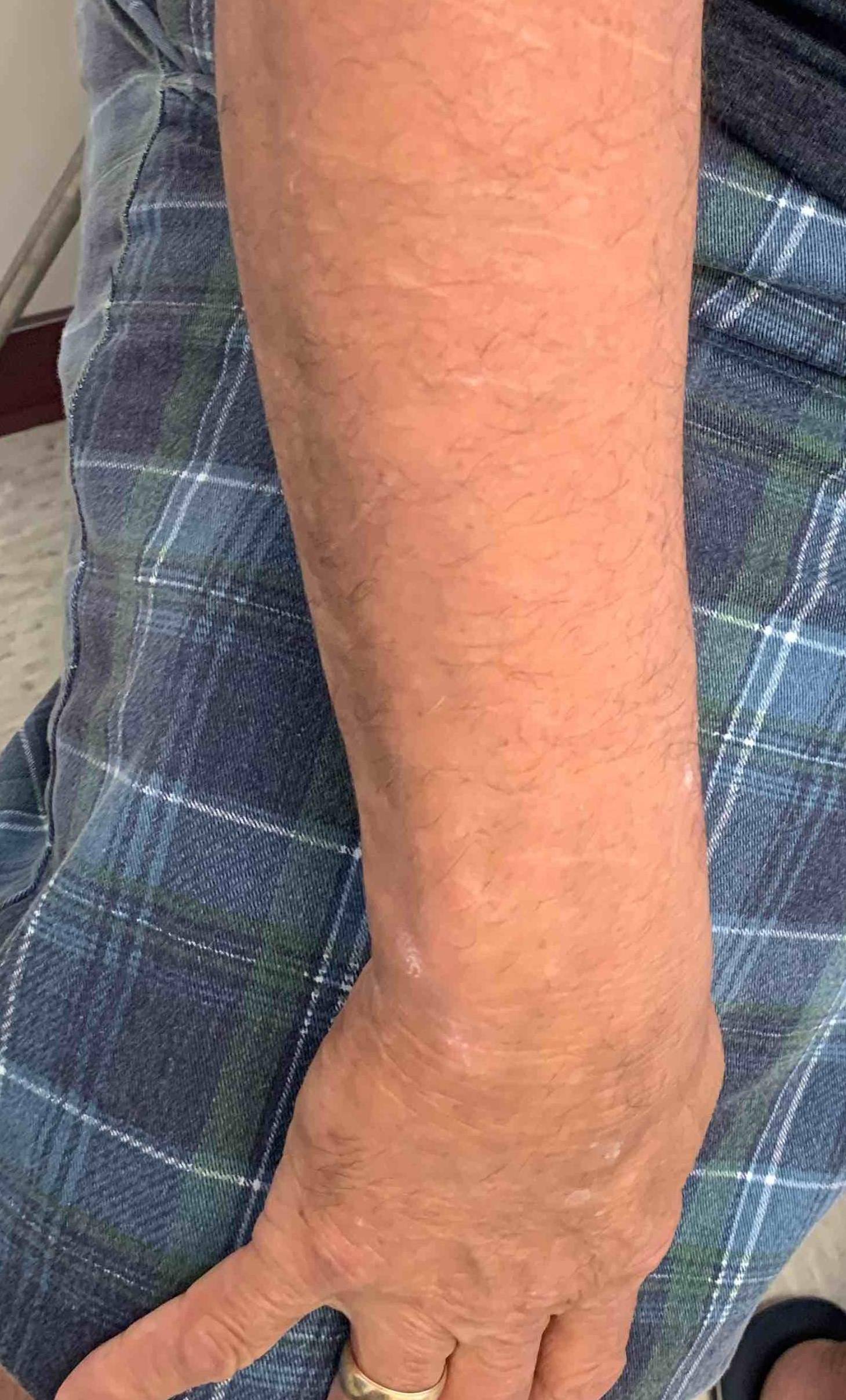 Psoriasis Before and After 36 After