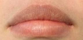 Juvederm (1 Syringe) Case-2 Before