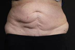 CoolSculpting<sup>®</sup> Before and After Case 6 Before