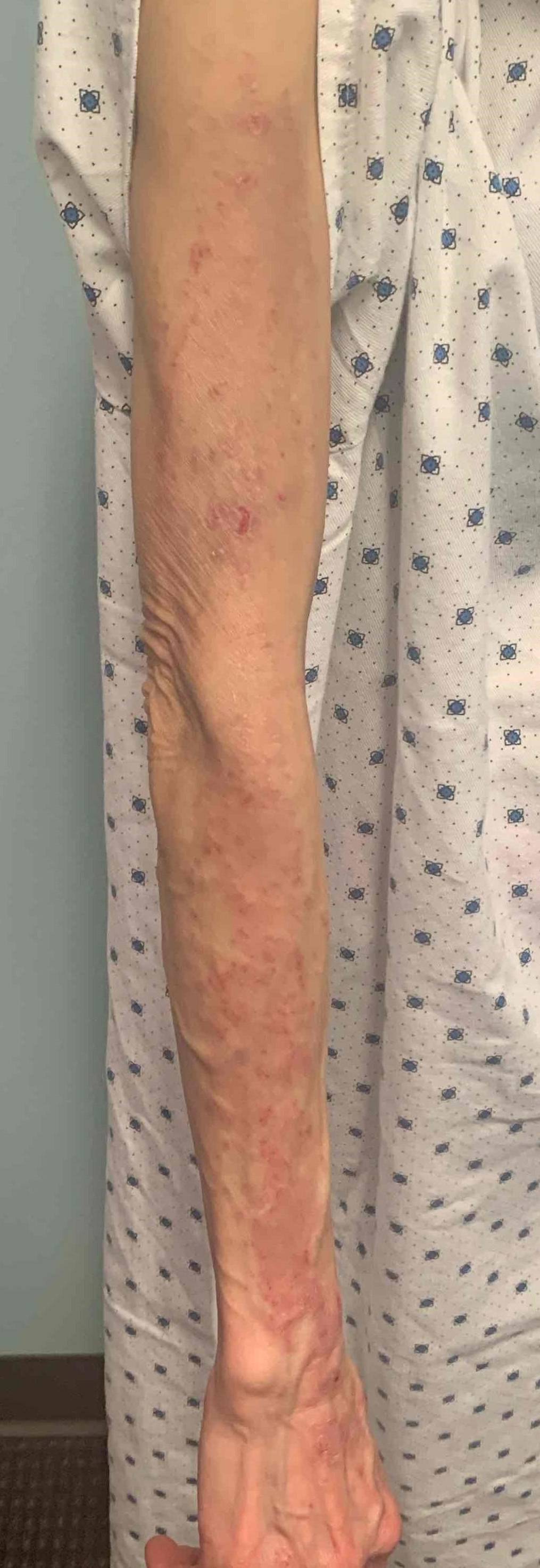 Atopic Dermatitis Before and After 19 Before