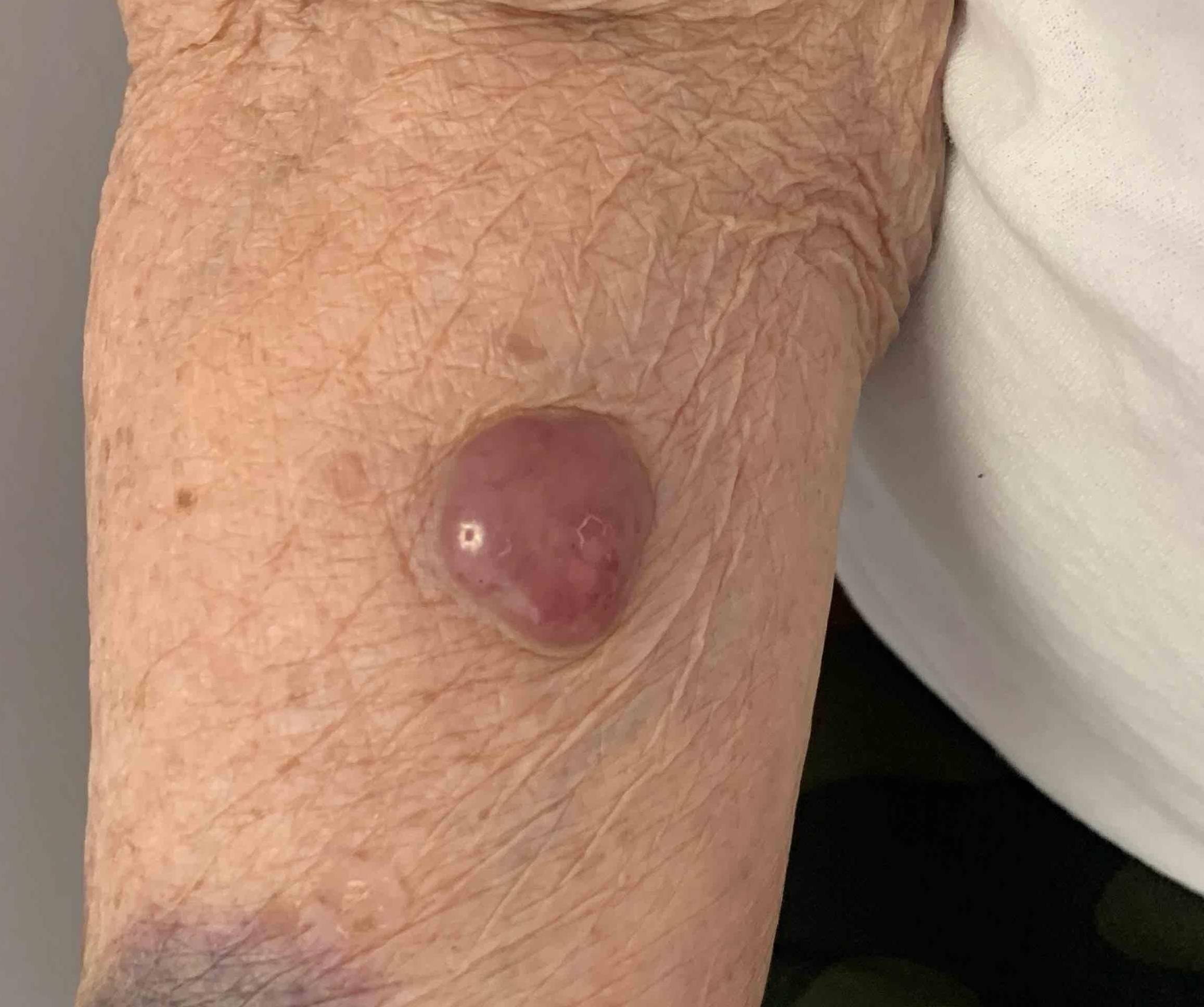 Cyst Removal Before and After Case-7 Before