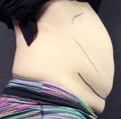 CoolSculpting<sup>®</sup> Before and After Case 7 Before