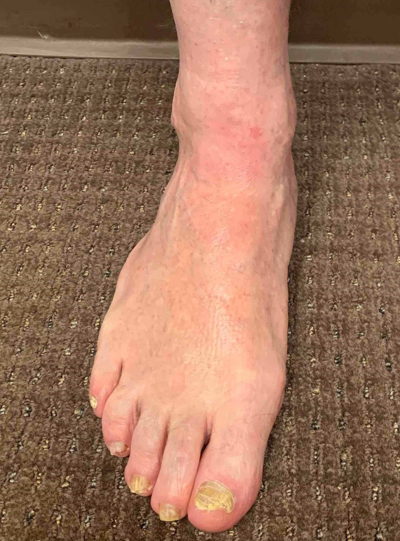 Eczema/ Atopic Dermatitis Before and After 20 After