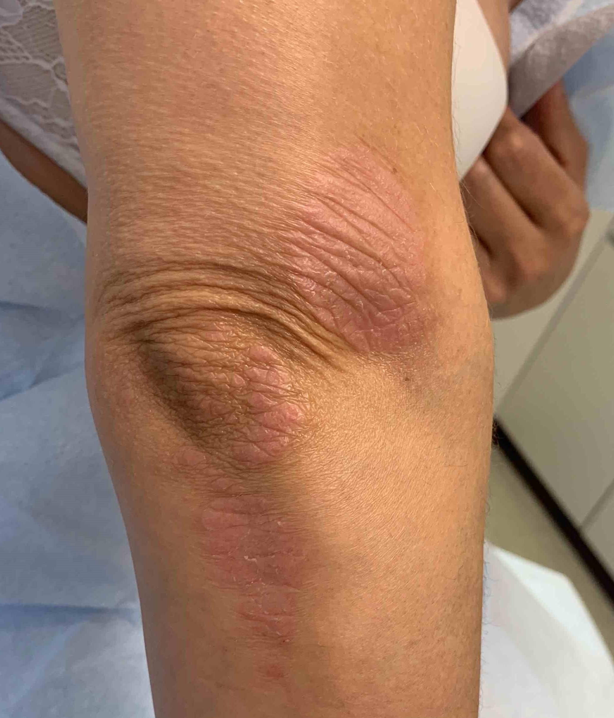 Psoriasis Before and After 38 Before