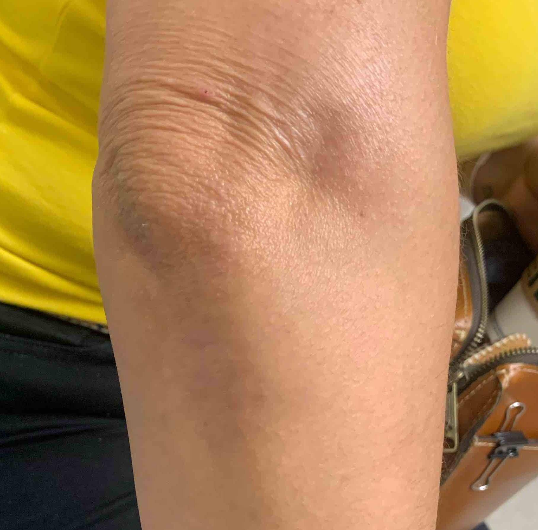 Psoriasis Before and After 38 After