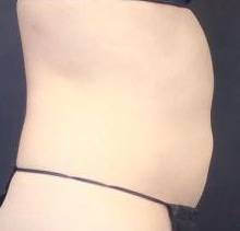 CoolSculpting<sup>®</sup> Before and After Case 7 After