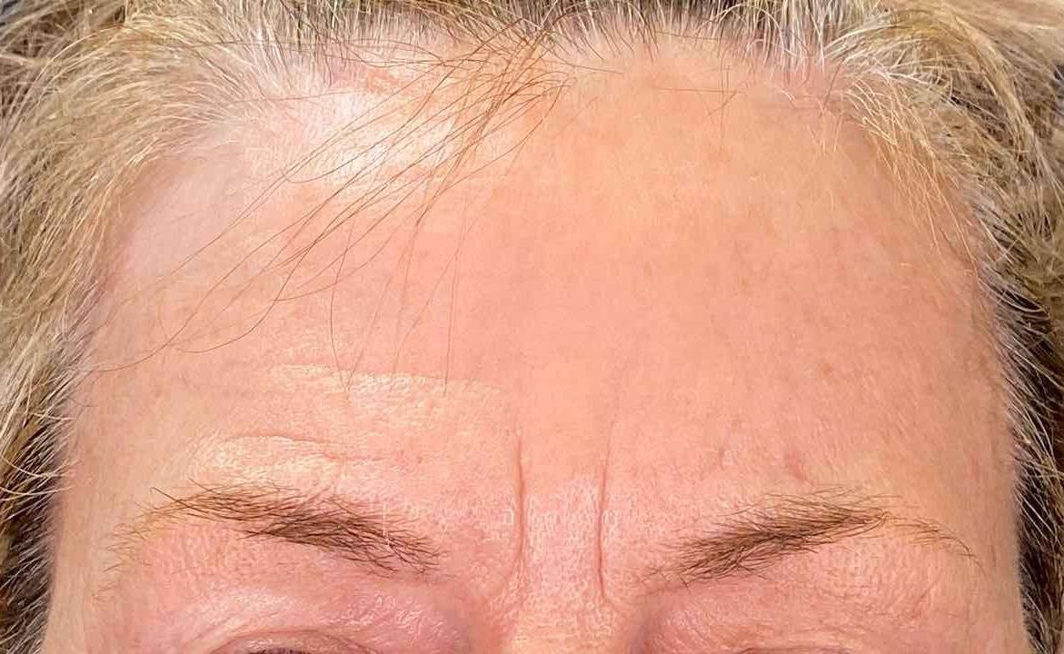 Volbella (1 syringe) Before and After 7 Before