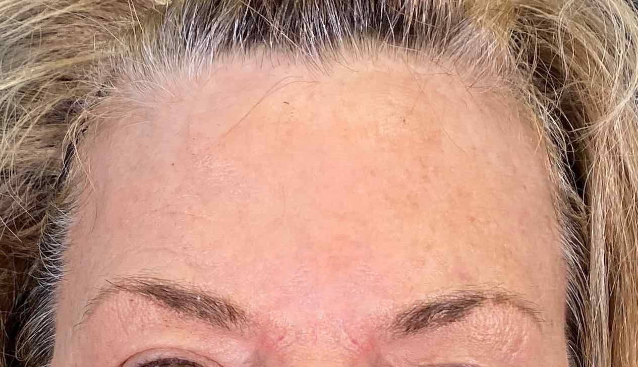 Volbella (1 syringe) Before and After 7 After