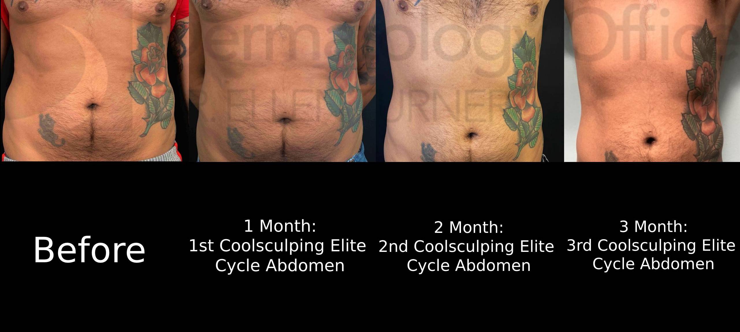 CoolSculpting Elite (3 Treatments) Case 1 