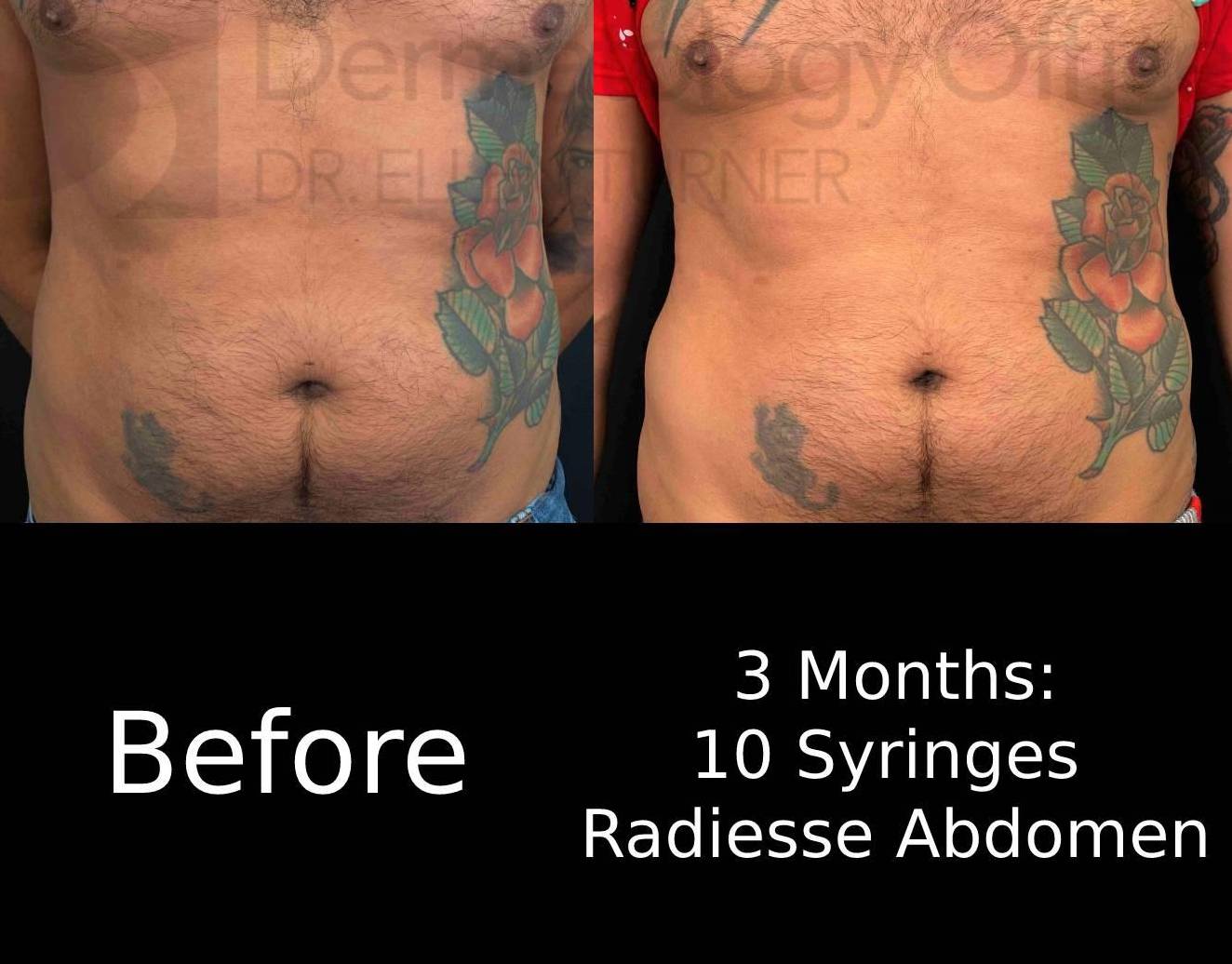 Radiesse Abdomen (10 Syringes) Case 4 