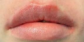 Juvederm (1 Syringe) Case-2 After