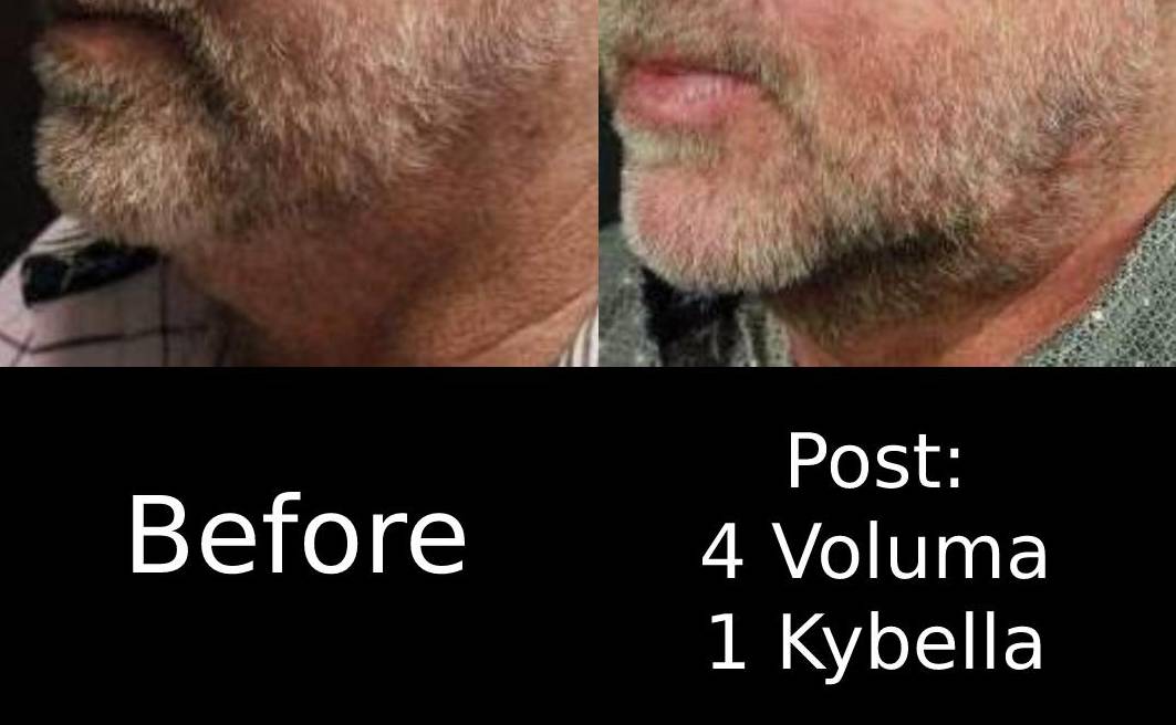 Facial Contouring with Filler (4 Voluma) Case-4 