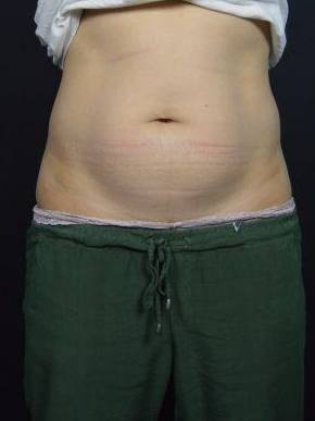 CoolSculpting<sup>®</sup> Before and After Case 9 Before