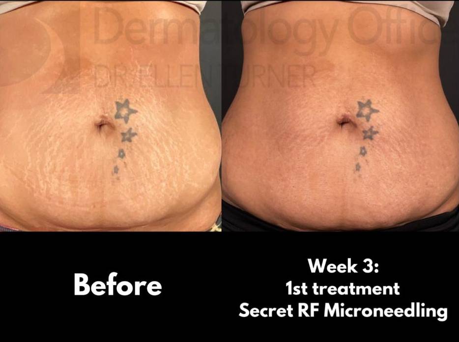 Cutera Secret RF Microneedling (1st Treatment) Case-1 