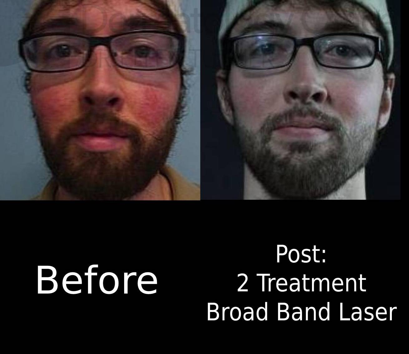 Rosacea (2 Treatment BBL) Case-1 