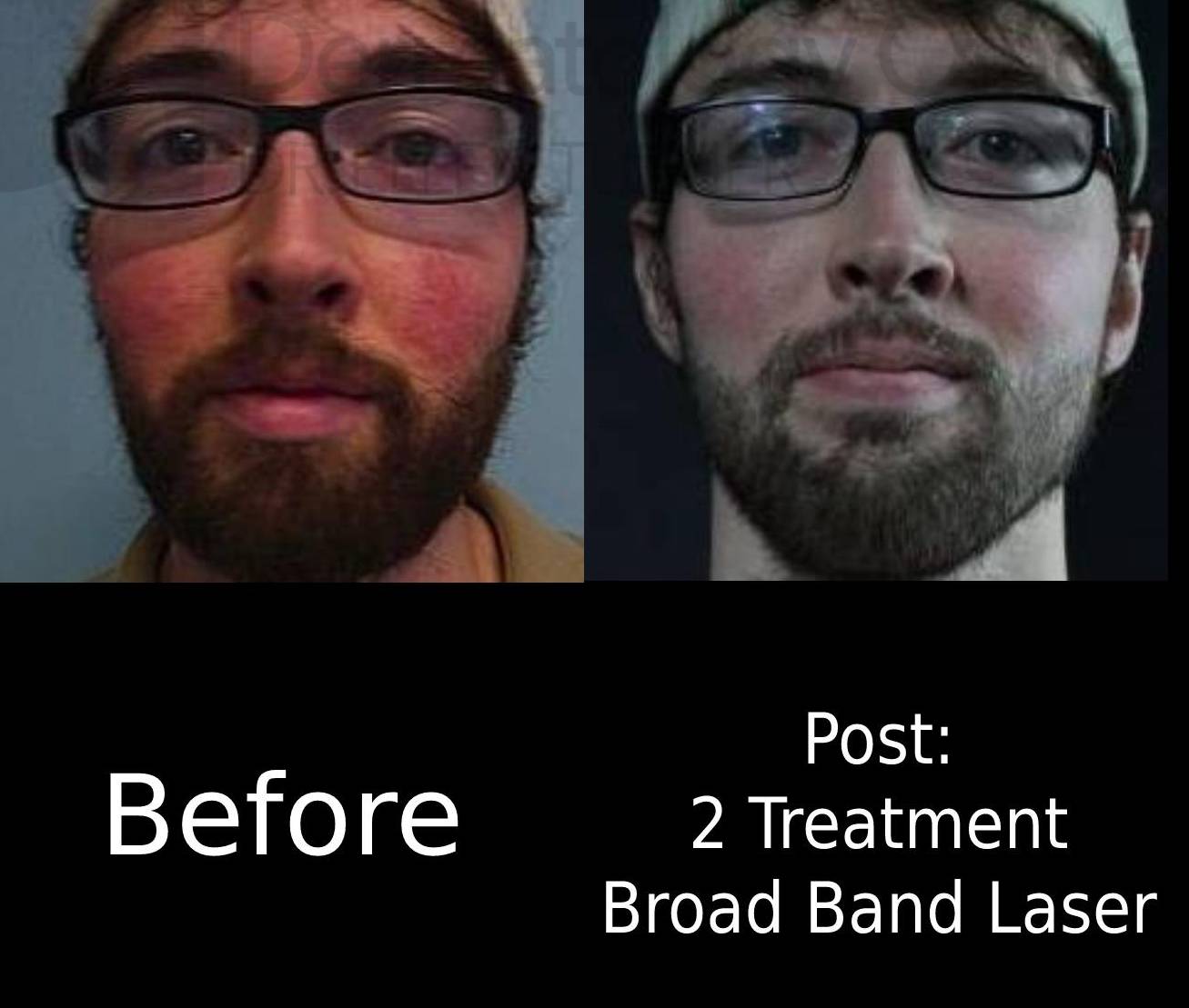 Rosacea (2 Treatment BBL) Case-8 